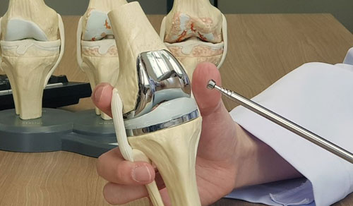 Knee Replacement