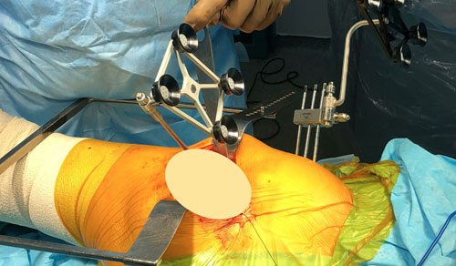 Robotic Hip Replacement Surgery