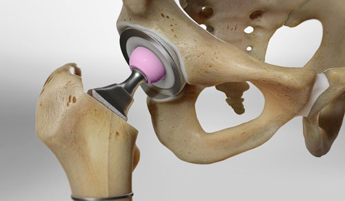 Hip Replacement