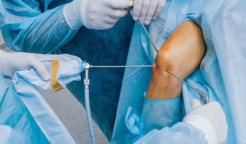 Arthroscopic Knee