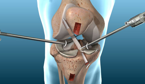 ACL Reconstruction