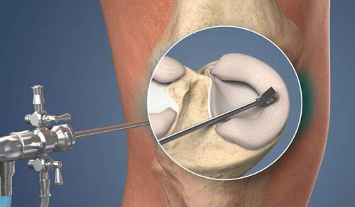 Meniscus Surgery